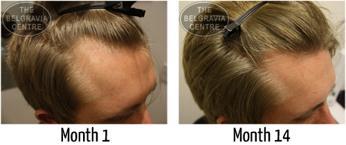 Male Pattern hair Loss Photoscans The Belgravia Centre