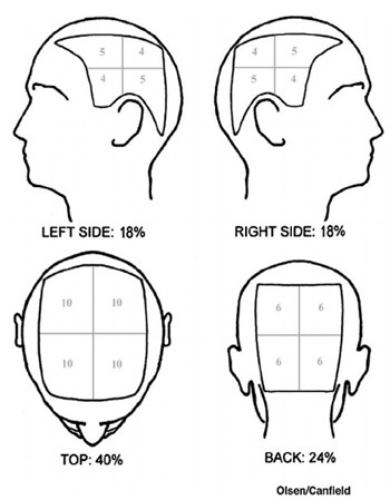 An Example of How Alopecia Areata SALT Scores are Allocated