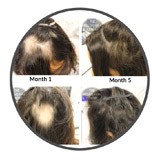 Circ The Belgravia Centre Hair Loss Treatment for Alopecia Areata