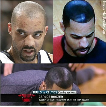 Carlos Boozer Before and After his Shoe Polish Hair Look to Hide Hair Loss